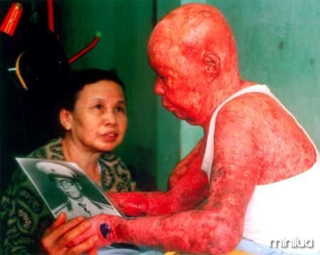 Agent-Orange-dioxin-skin-damage-Vietnam