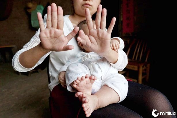 Polydactyly Chinese Baby